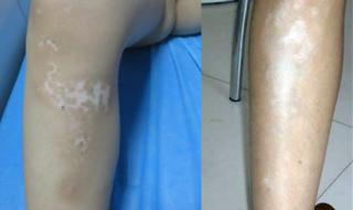 白癜风早期症状图片